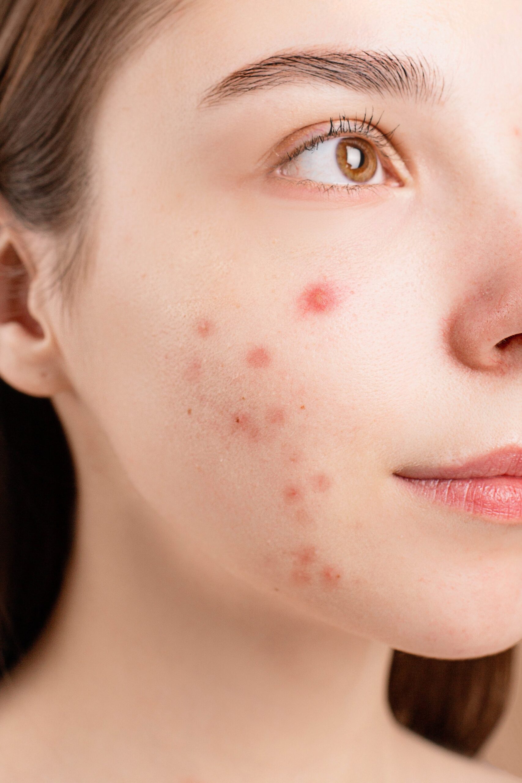 What is an Acne?